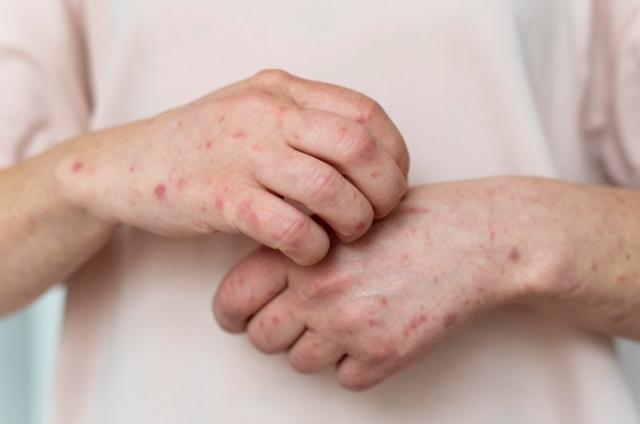 Buy Metronidazole Online: Your Complete Guide to Safe and Effective Infection Treatment